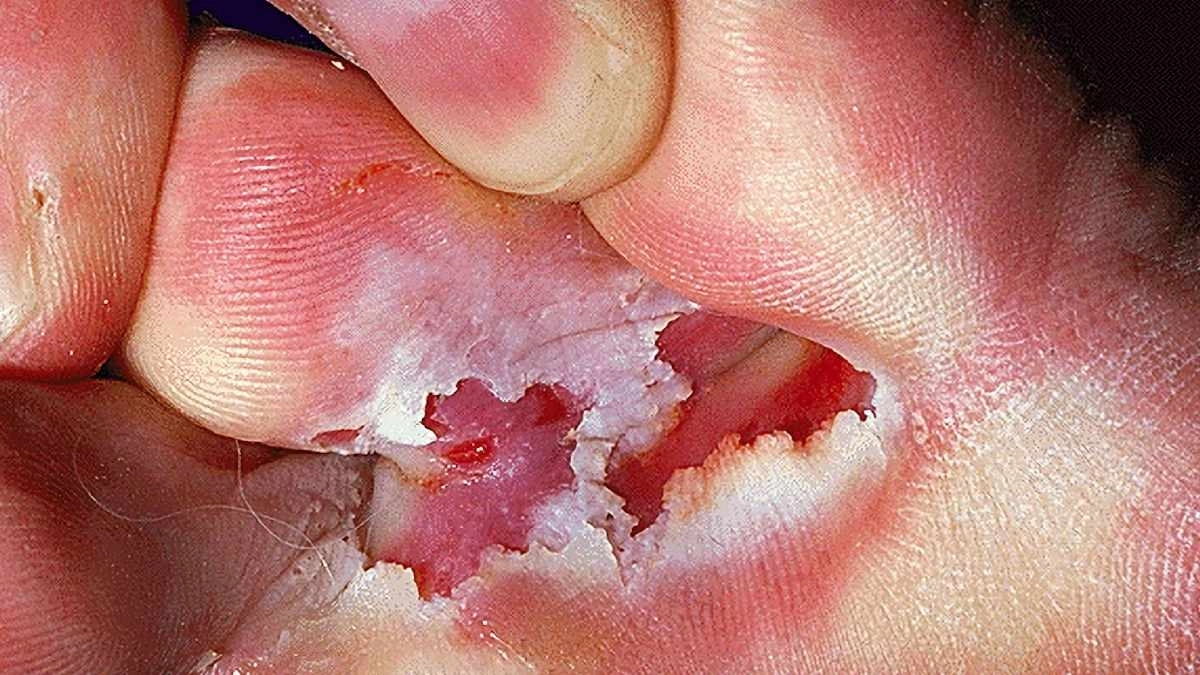 Tinea Pedis Fungal Infection can cause Athletes foot symptoms